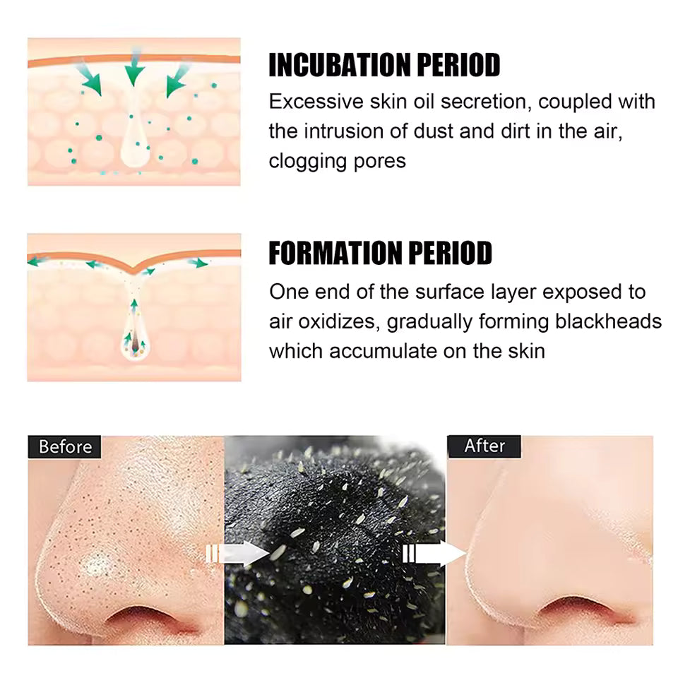 Blackhead Removal Nose Strips